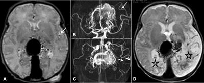 Pseudo-feeders as a red flag for impending or ongoing severe brain damage in Vein of Galen aneurysmal malformation